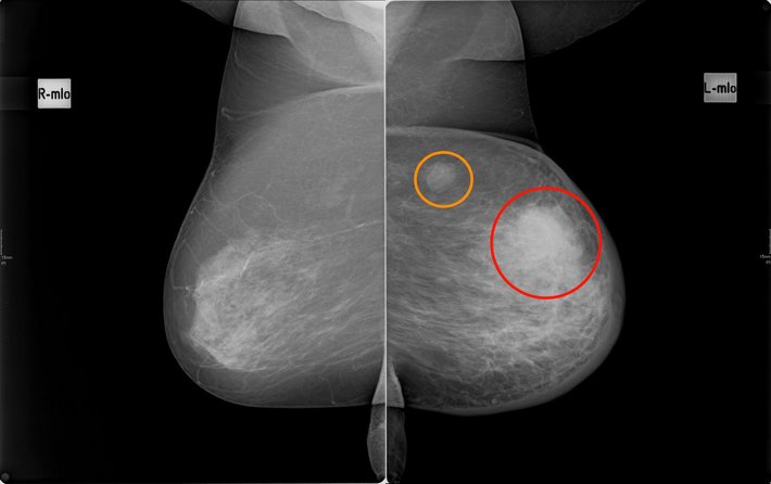 Mammadiagnostik Brustkrebs (© Dr. Sina Seyfried) Diese zwei Bilder zeigen die Brüste einer Patientin mit Brustkrebs in der linken Brust. Die beiden Knoten sind mit dem orangenen und roten Kreis markiert.