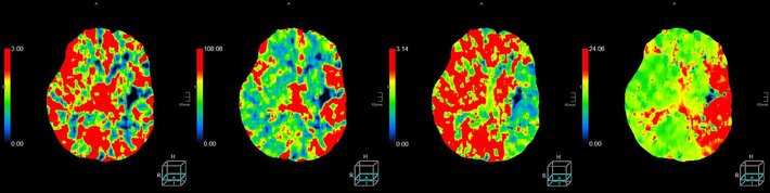 Diese Bilder zeigen ein Perfusions CT, in diesem CT kann man vor allem im rechten Bild den großen roten Bereich erkennen, welcher z. B. durch eine Thrombektomie noch zu retten ist. 