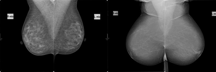 Mammadiagnostik (© Dr. Sina Seyfried) Die ersten zwei Bilder zeigen die Brüste einer jungen gesunden Frau. Das dritte und vierte Bild zeigen die gesunden Brüste einer Frau im fortgeschrittenen Alter. Mit zunehmendem Alter nimmt das Drüsengewebe ab und die Brust wird durchsichtiger.